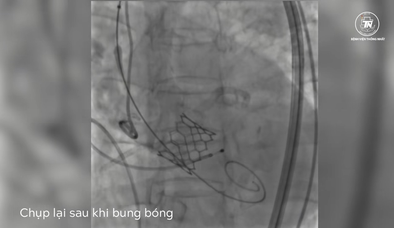 Hình ảnh chụp lúc bung van động mạch chủ. Hình ảnh chụp lúc bung van động mạch chủ.