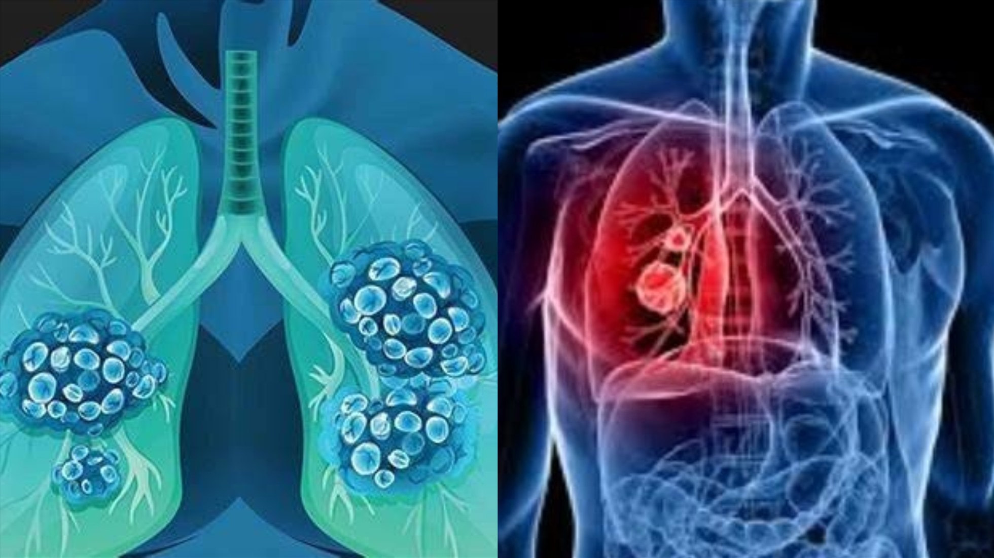 Cảnh báo không thể bỏ qua: Dấu hiệu sớm của UNG THƯ phổi không phải ho mà là 5 bất thường trên cơ thể - Ảnh 1. Cảnh báo không thể bỏ qua: Dấu hiệu sớm của UNG THƯ phổi không phải ho mà là 5 bất thường trên cơ thể - Ảnh 1.
