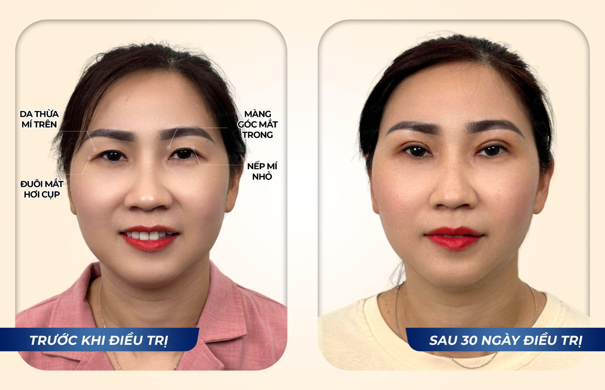 Hành trình trẻ hóa đôi mắt, lấy lại sự tự tin cho người mẹ hai con - chị Vòng Xuân Hạnh- Ảnh 3. Hành trình trẻ hóa đôi mắt, lấy lại sự tự tin cho người mẹ hai con - chị Vòng Xuân Hạnh- Ảnh 3.