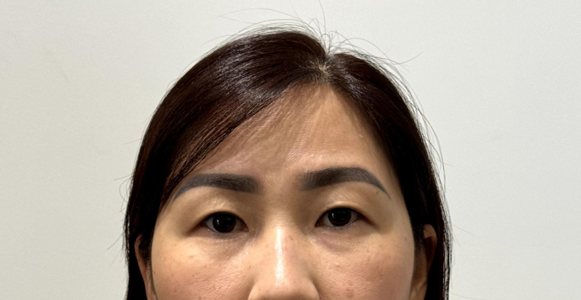 Hành trình trẻ hóa đôi mắt, lấy lại sự tự tin cho người mẹ hai con - chị Vòng Xuân Hạnh- Ảnh 2. Hành trình trẻ hóa đôi mắt, lấy lại sự tự tin cho người mẹ hai con - chị Vòng Xuân Hạnh- Ảnh 2.