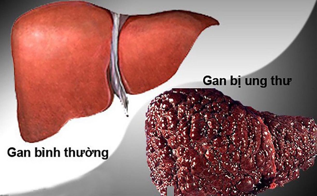 WHO gọi tên chất gây ung thư nghiêm trọng – Ẩn mình trong món ăn quen thuộc của người Việt
- Ảnh 1. WHO gọi tên chất gây ung thư nghiêm trọng – Ẩn mình trong món ăn quen thuộc của người Việt
- Ảnh 1.