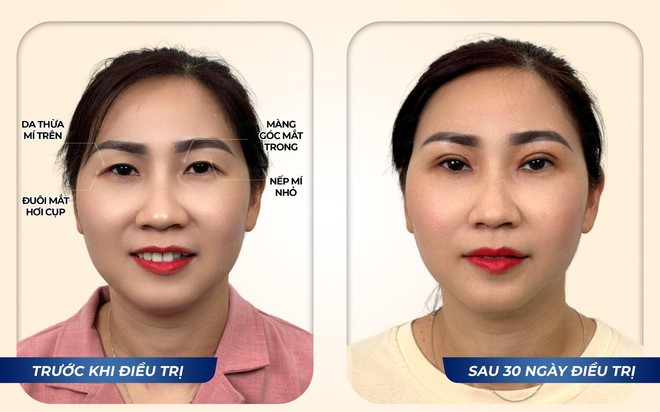 Hành trình trẻ hóa đôi mắt, lấy lại sự tự tin cho người mẹ hai con - chị Vòng Xuân Hạnh- Ảnh 1. Hành trình trẻ hóa đôi mắt, lấy lại sự tự tin cho người mẹ hai con - chị Vòng Xuân Hạnh- Ảnh 1.